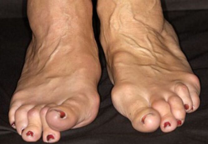 Arthrosis deformation