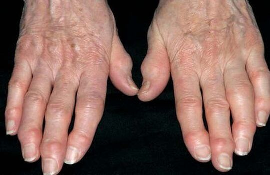 Arthrosis of the hands