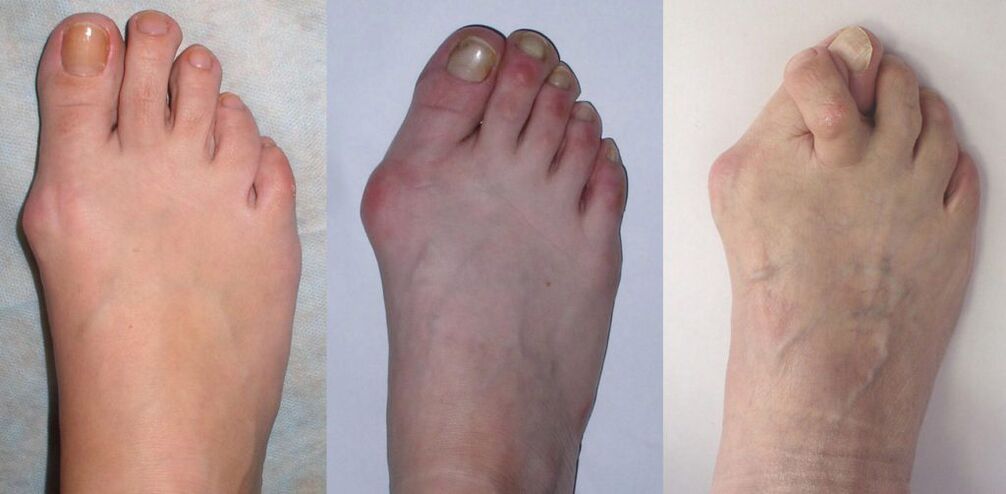 Foot -arthritis