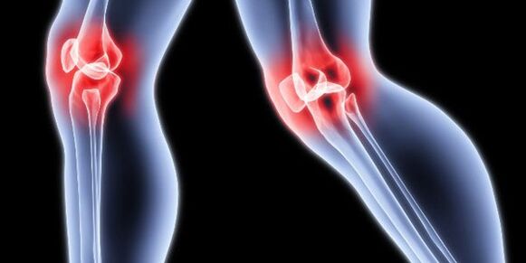 Knee arthrosis
