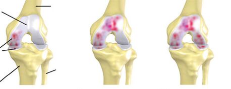 arthrosis