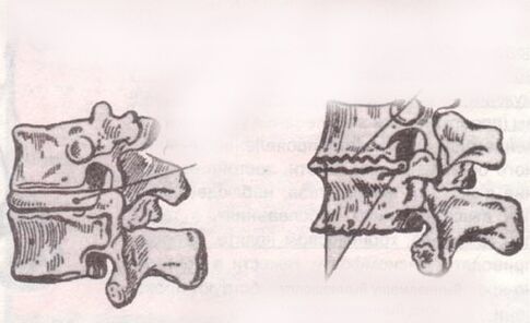 The intervertebral disc is healthy and with lumbar osteochondrosis