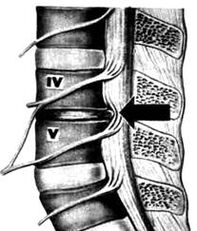 X -ray photo of the lumbar osteochondrosis department