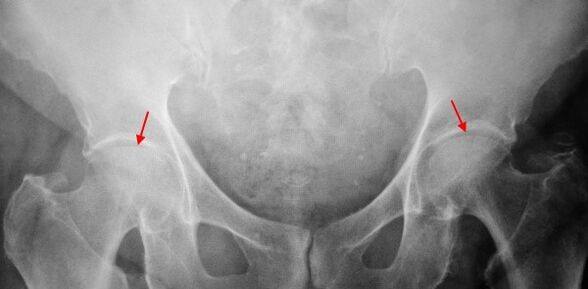 Bilateral coxarthrosis-resistance to joint precipice, sclerosis of the joint surfaces