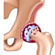 Hip arthrosis