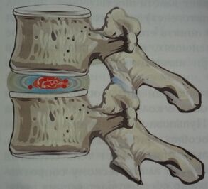 First stage of osteochondrosis