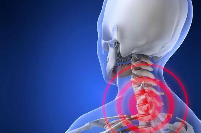 Shooting pain in the neck is an early symptom of cervical osteochondrosis